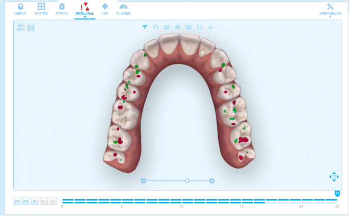 Align Technology Introduces the Invisalign® Palatal Expander