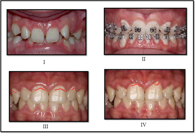 GC MI Paste with Recaldent, MI-paste, How to remineralize teeth, Remin 