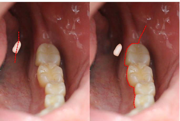 Displacement Of Lower Third Molar Into