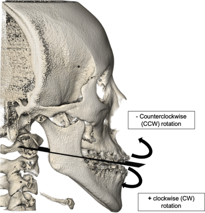 Clockwise versus counterclockwise rotation in bimaxillary surgery: 3D  analysis of facial soft tissue outcomes