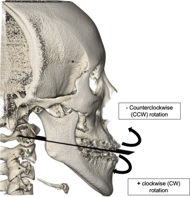 Clockwise versus counterclockwise rotation in bimaxillary surgery