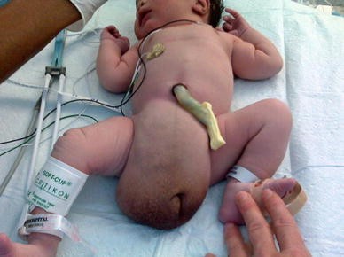 Inguinal Hernia Surgery - Very common in preterm babies, Southern Gem