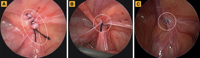 Figure 2 from Purse-String Suture for Round and Oval Defects: A Useful  Technique in Dermatologic Surgery | Semantic Scholar