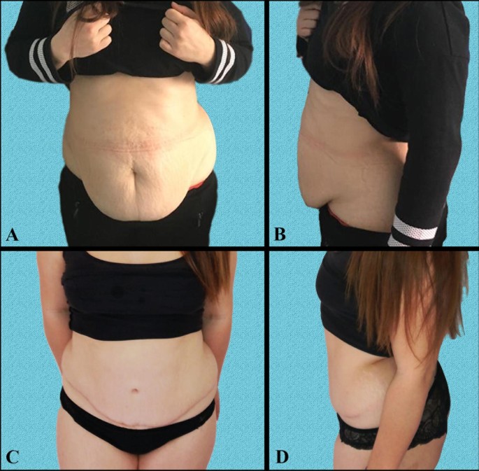 Severe diastasis recti can be treated with surgery