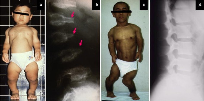 dwarfism pseudoachondroplasia
