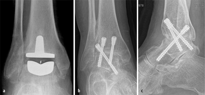 Arthrodese vs. Prothese am oberen Sprunggelenk | Trauma und Berufskrankheit  | Springer Nature Link