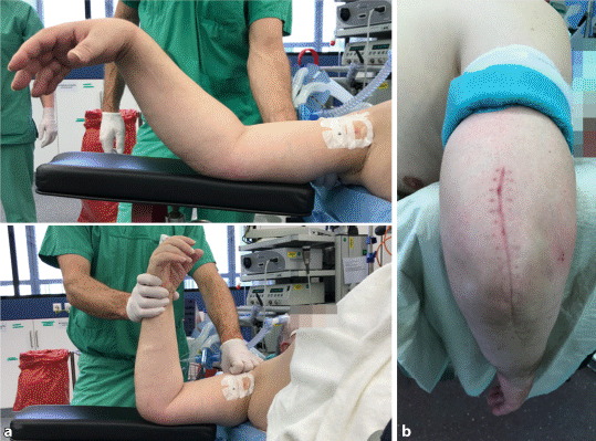 Steifer posttraumatischer Ellenbogen | Trauma und Berufskrankheit |  Springer Nature Link