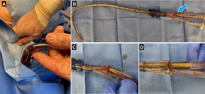 Fracture of dual lumen cannula leading to cerebrovascular accident in a  patient supported with ECMO | Journal of Artificial Organs