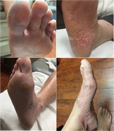Hiker's feet”: a novel cutaneous finding in the inflammatory myopathies |  Clinical Rheumatology