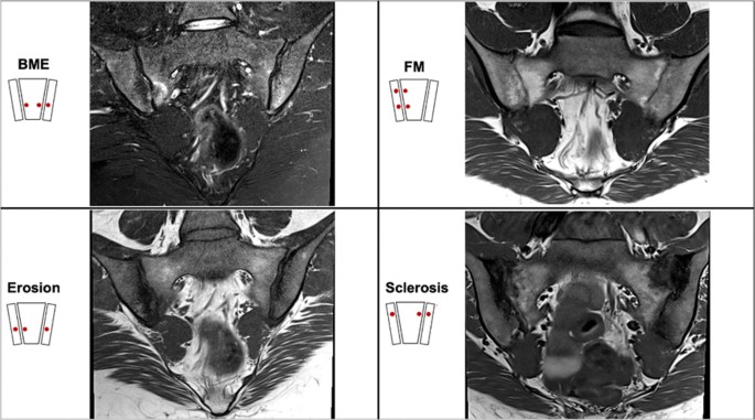Clinical and MRI features associated with remission following biological therapy in axial spondyloarthritis - Clinical Rheumatology
