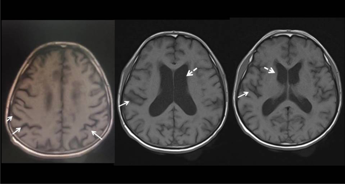 Niemann-Pick disease types A and B (NORD): Video