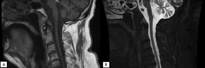 Rare association between spinocerebellar ataxia and amyotrophic lateral sclerosis: a case series