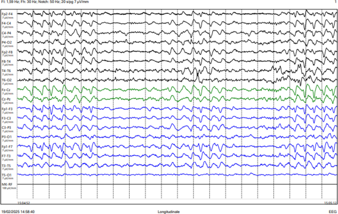 can tirzepatide cause seizures Probable tirzepatide-associated limbic encephalitis with status epilepticus  in a patient with extreme obesity: a case report | Neurological Sciences