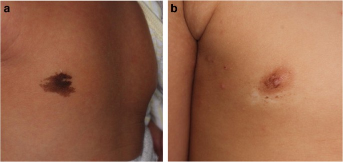 Combination laser therapy as a non-surgical method for treating congenital  melanocytic nevi from cosmetically sensitive locations on the body | Lasers  in Medical Science
