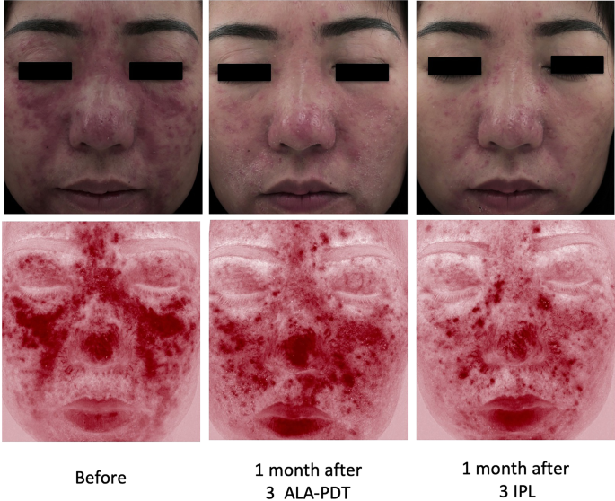 glutathione and rosacea Integrative Approach to Managing Rosacea