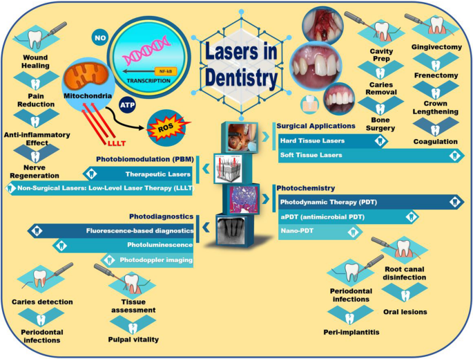 A comprehensive review on advancements in laser-assisted dental treatments:  focus on minimally invasive techniques and clinical outcomes | Lasers in  Medical Science | Springer Nature Link