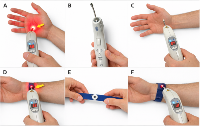 Photobiomodulation with or without ILIB in diabetic peripheral neuropathy: a randomized pilot trial - Lasers in Medical Science