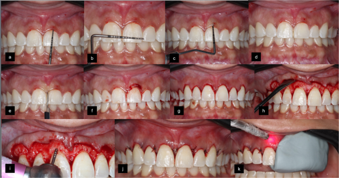 Photobiomodulation for primary wound healing and patient-reported outcomes after esthetic crown lengthening surgery: A pilot randomized clinical trial - Lasers in Medical Science