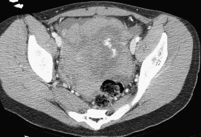 Spontaneous hemoperitoneum: a bloody mess