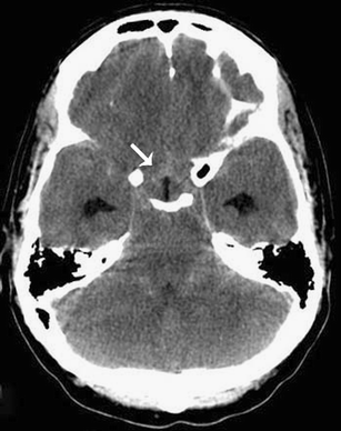 Subarachnoid hemorrhage  Radiology Reference Article