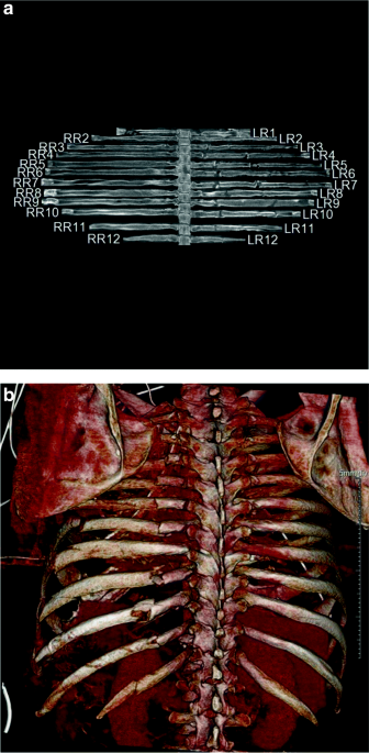 Blunt chest trauma: classification and management | Emergency Radiology