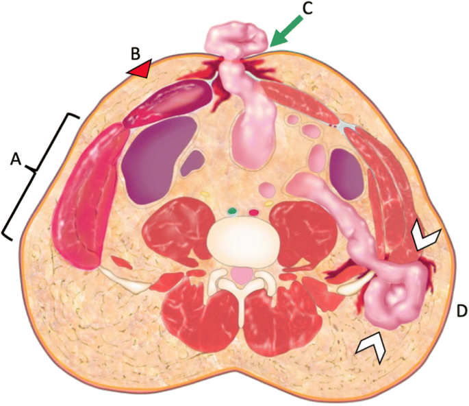 Cureus  Traumatic Lateral Abdominal Wall Hernia: A Rare