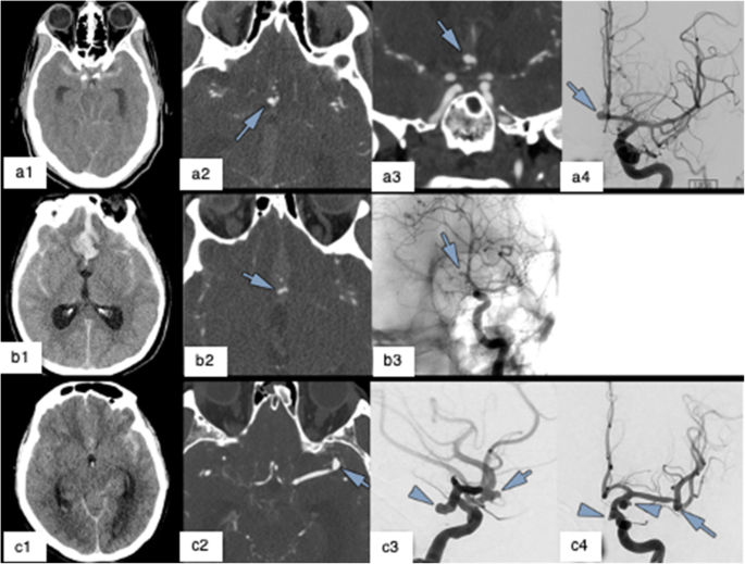 Imaging Evaluation of SAH and Aneurysm