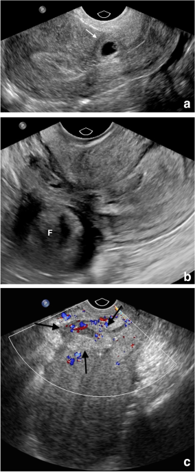Actively leaking ectopic pregnancy | Radiology Case | Radiopaedia.org