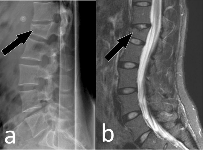 Radiographic assessment of acute vs chronic vertebral compression fractures