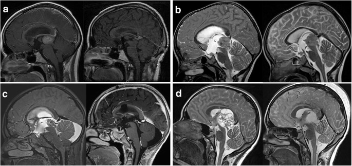 Outcomes and surgical approaches for pineal region tumors in children: 30  years' experience in: Journal of Neurosurgery: Pediatrics Volume 32 Issue 2  (2023) Journals