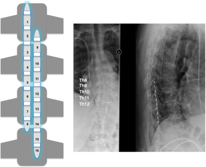 What You Need to Know About Nevro HF10 Spinal Cord Stimulation