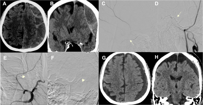 Predictors of recurrence and reintervention in non-acute subdural hematoma: A multimodal analysis of radiological, clinical, surgical, and endovascular factors - Neurosurgical Review