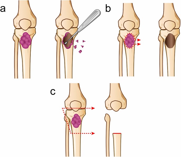 The role of surgery in the treatment of metastatic bone tumor |  International Journal of Clinical Oncology