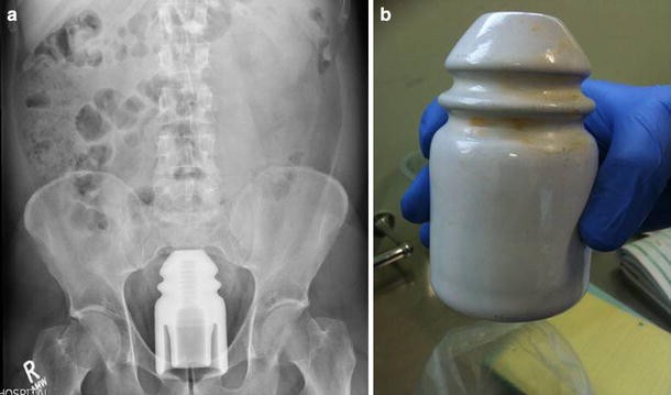 Approach to the diagnosis and management of retained rectal foreign bodies:  clinical update | Techniques in Coloproctology