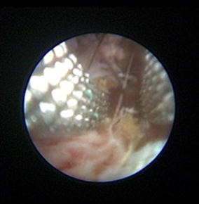 Endoscopic pilonidal sinus treatment (E.P.Si.T.): a minimally invasive  approach - ScienceDirect