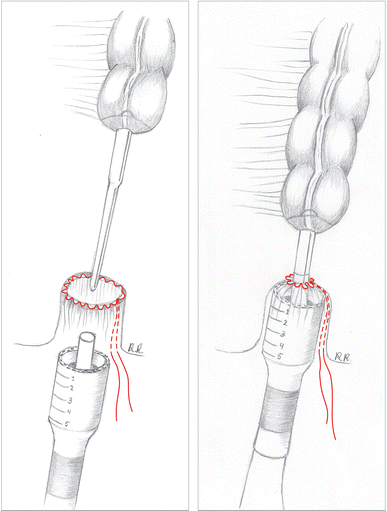 Current applications of endoscopic suturing