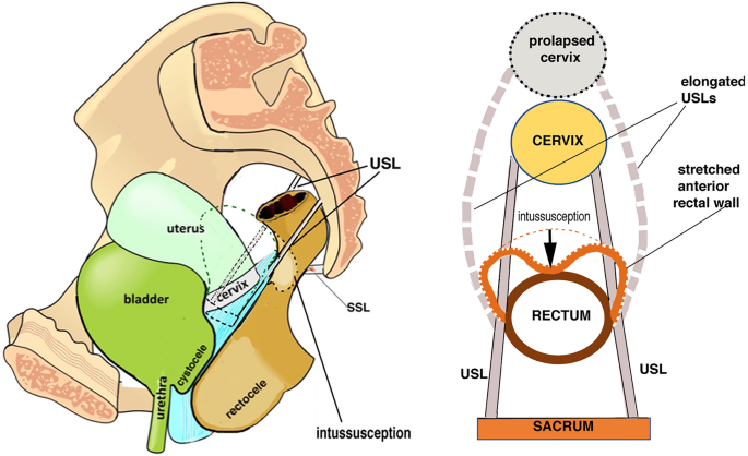 The biomechanics of uterine prolapse impact rectal intussusception