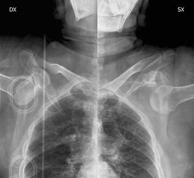 A case of bilateral elbow dislocation in a patient with Rubinstein