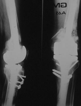 Cureus, Congenital Pseudoarthrosis of Tibia With Anterolateral Bowing  Treated With Ilizarov Ring Fixator: A Case Report