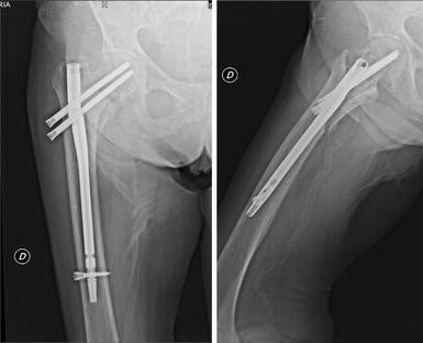 Cureus | Surgical Treatment of Type 31-A1 Two-part Intertrochanteric Femur  Fractures: Is Proximal Femoral Nail Superior to Dynamic Hip Screw Fixation?  | Article