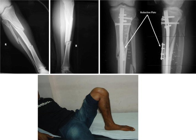 Intramedullary Nailing of Proximal Tibial Fractures
