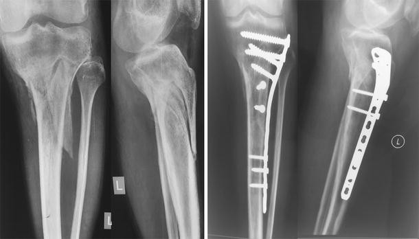 Fractures of the Proximal Third Tibia Treated With Intramedullary  Interlocking Nails and Blocking Screws | Al-Toukhy | International Journal  of Orthopaedics