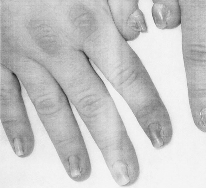 Pincer nail in a lupus patient | Semantic Scholar