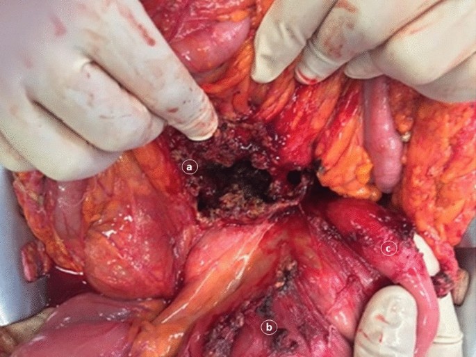 Intraabdominal sporadic desmoid tumors and inflammation: an updated  literature review and presentation and insights on pathogenesis of  synchronous sporadic mesenteric desmoid tumors occurring after surgery for  necrotizing pancreatitis | Clinical and ...