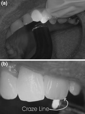 Bleaching induced tooth sensitivity: do the existing enamel craze lines  increase sensitivity? A clinical study
