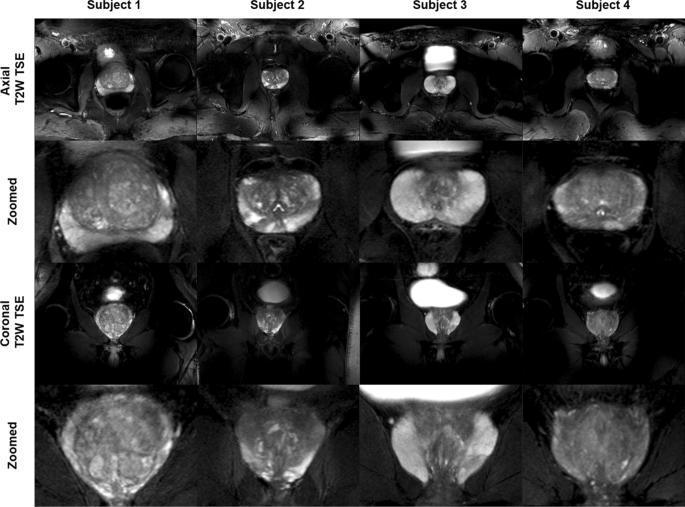 Ultra-high-field MR in Prostate cancer: Feasibility and Potential