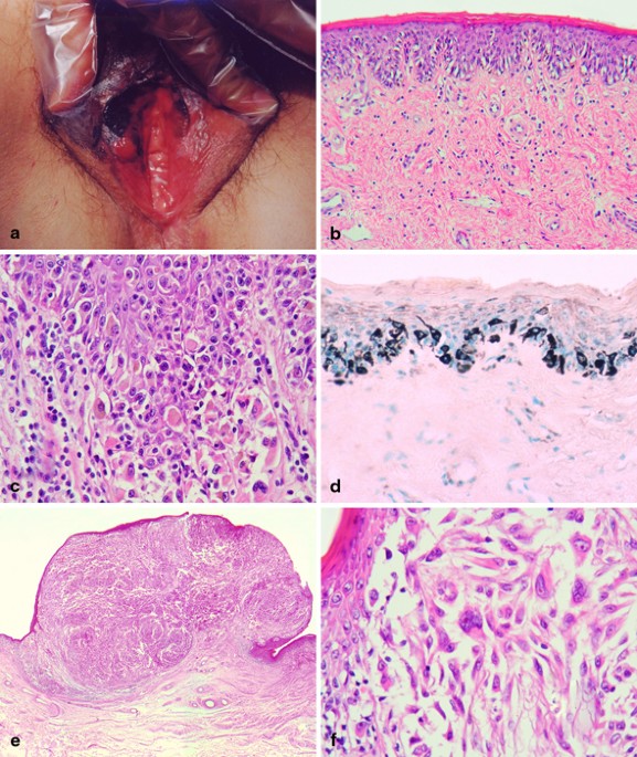mucosal atypical melanotic lesion labia young female Vulvar Melanosis: Two Case Report Vulvar Cysts, Adenocarcinoma, Melanocytic, and