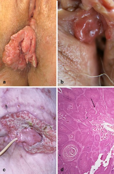 Vulvar cancer: a review for dermatologists | Wiener Medizinische  Wochenschrift