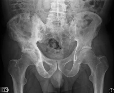 Imaging of Paget's disease of bone | Wiener Medizinische Wochenschrift