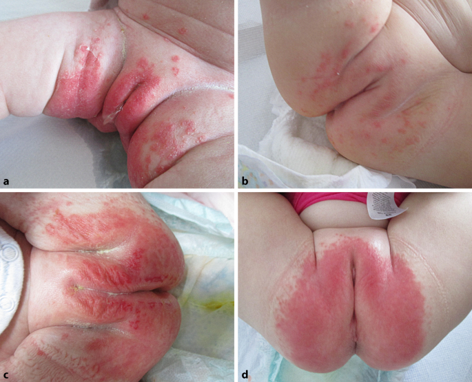 Diaper dermatitis—a narrative review of clinical presentation, subtypes,  and treatment